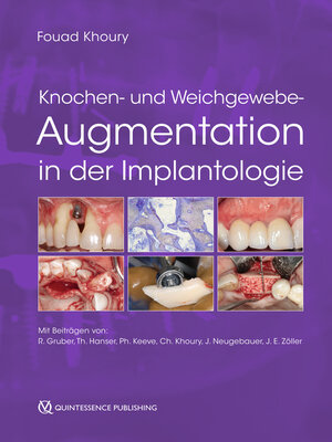 cover image of Knochen- und Weichgewebeaugmentation in der Implantologie